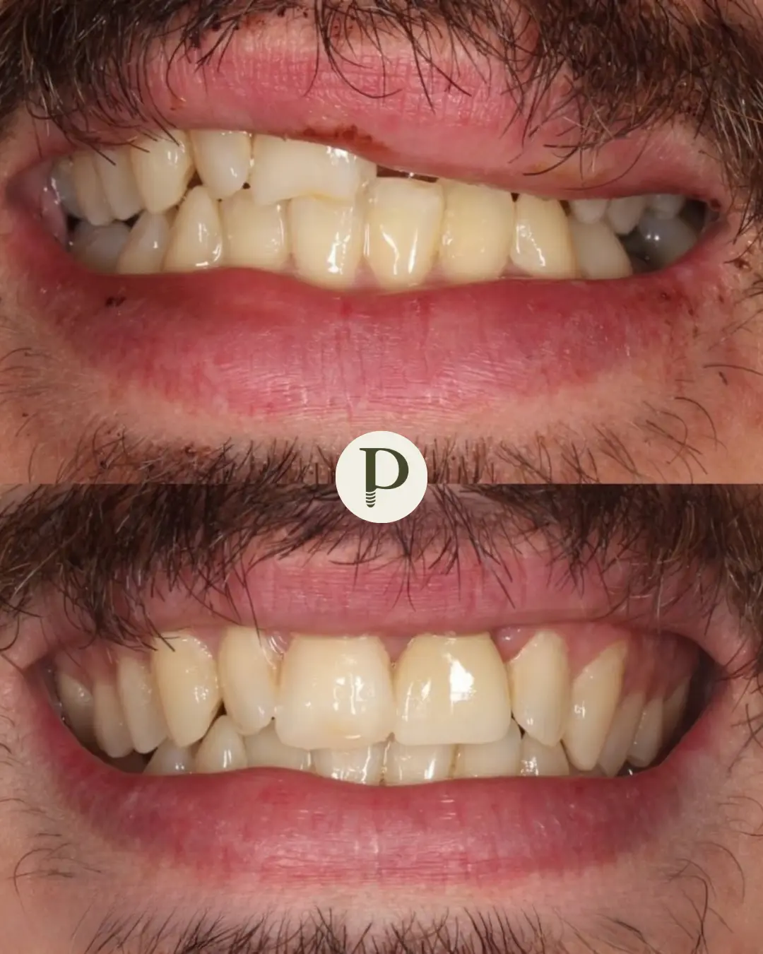 Before and after emergency dental treatment at Primadent Liverpool